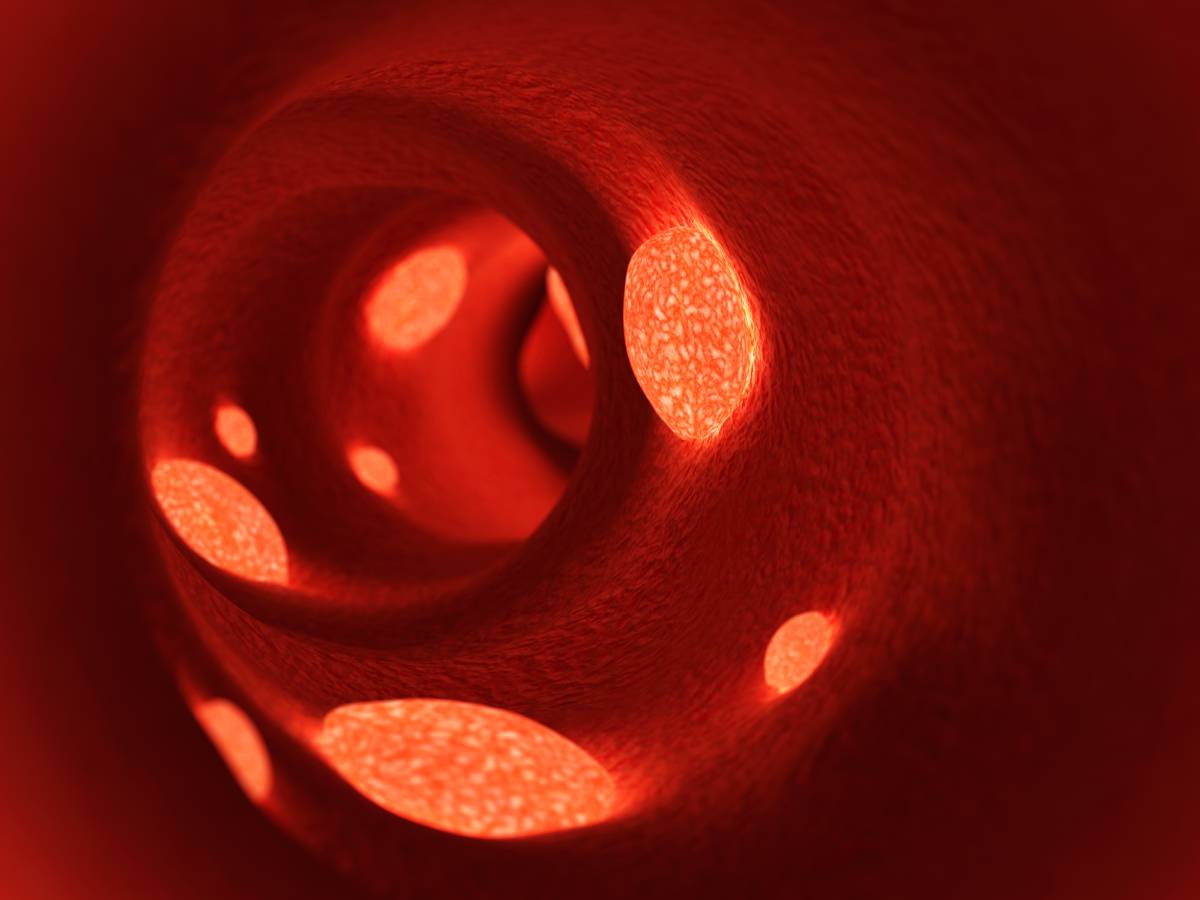 Disseminated Intravascular Coagulation