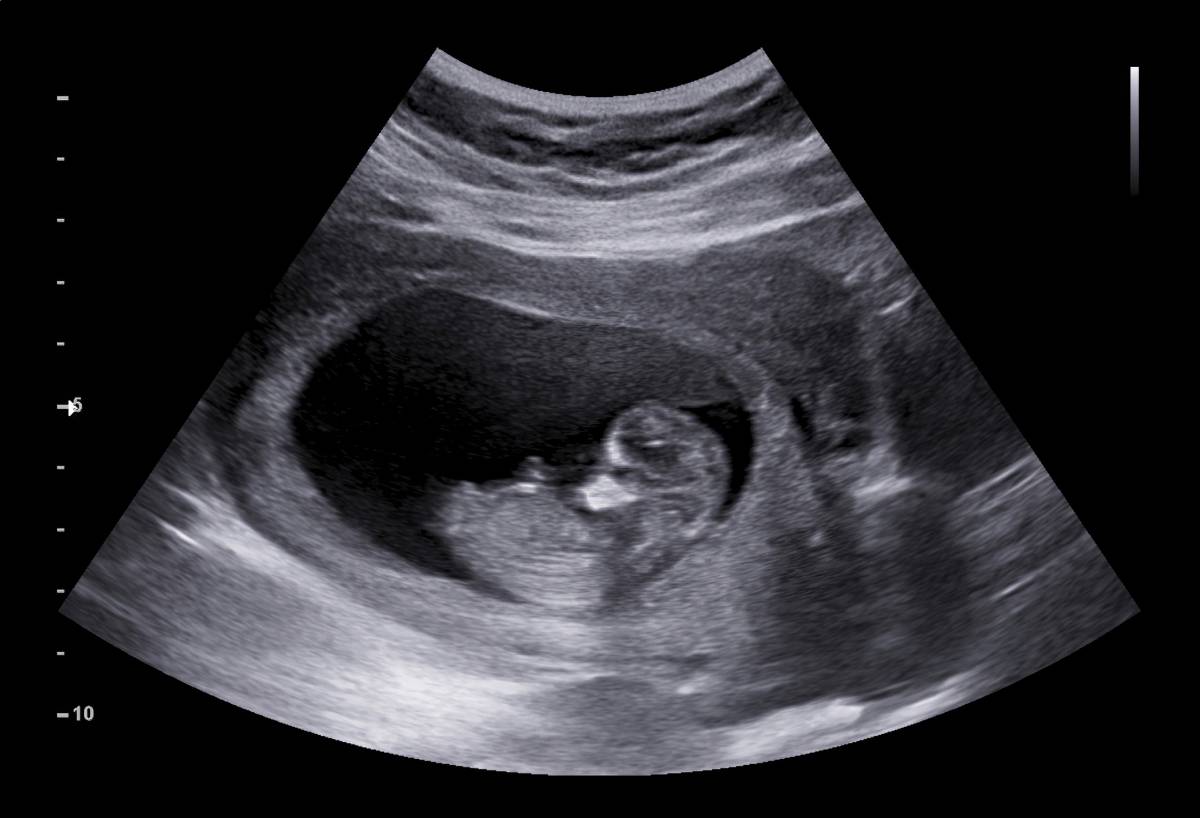 Surgery In Utero: Overview and Anesthesia 